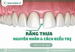 Cách Trị Răng Thưa